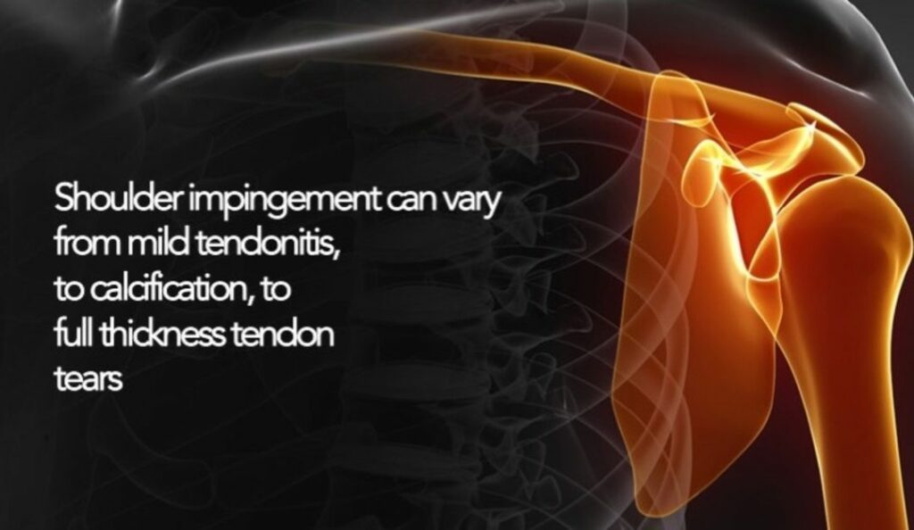 Shoulder impingement varying degrees of tendinopathy 1080x627 1